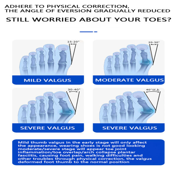 Upgraded Bunion Corrector for Women & Men, Orthopedic Bunions Correction with Non-Slip Big Toe Separators, Adjustable Bunion Splint Suitable for Left/Right Feet Bunion Relief (1PCS) - Image 8
